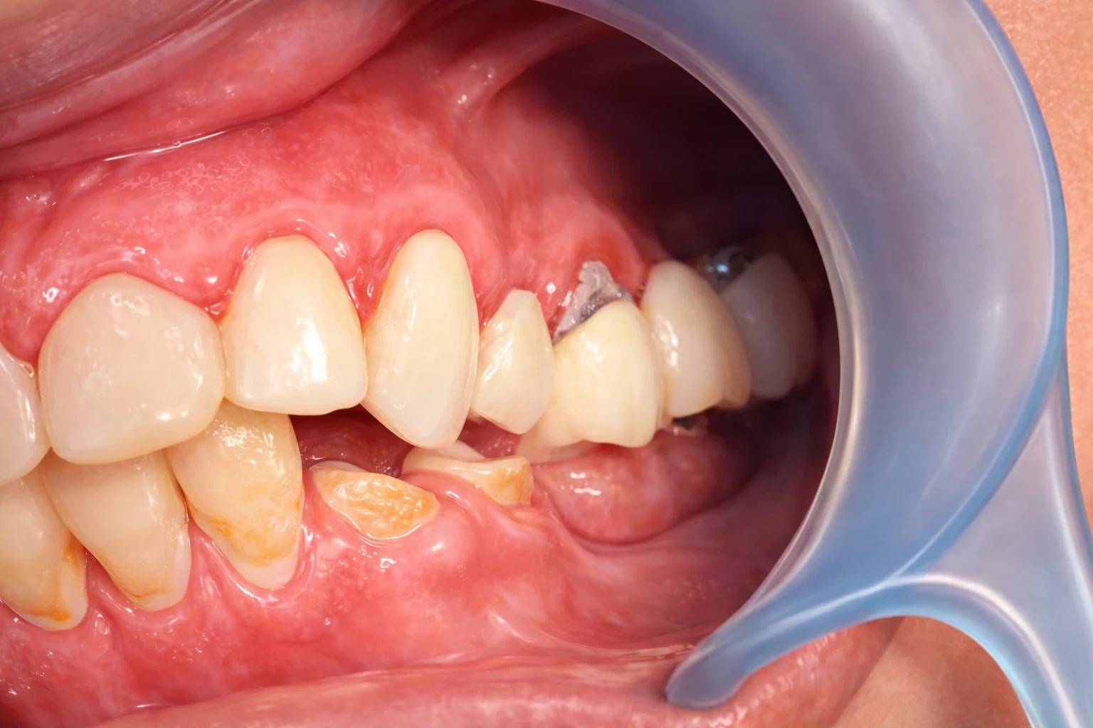 치태와 치석의 위험성