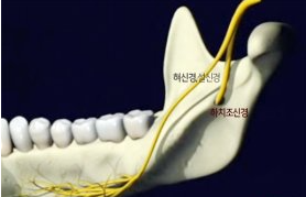 사랑니 발치 후 감각 이상 없이 안정적으로 회복된 구강 상태 이미지