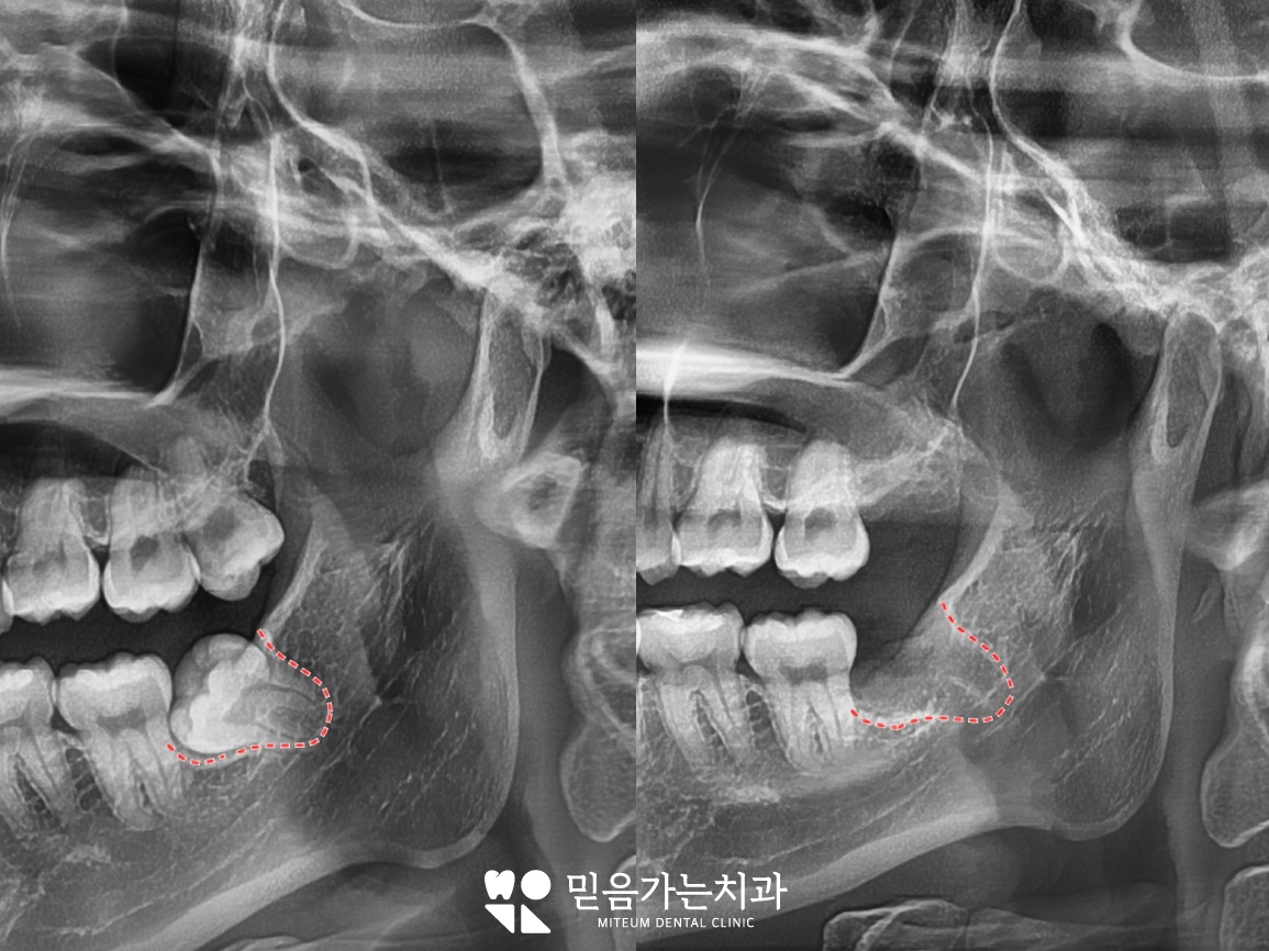 청량리 치과 믿음가는치과 수면마취(의식하진정법) 사랑니 발치 파노라마 엑스레이 및 발치 과정 임상사진