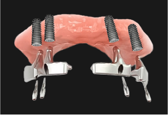 틀니 연결장치 부착