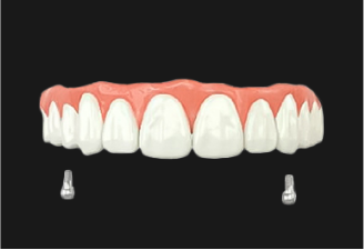 연결장치에 틀니 고정