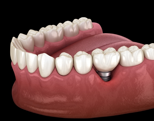 임플란트 이미지