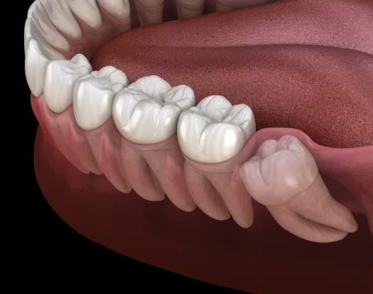 매복사랑니 이미지